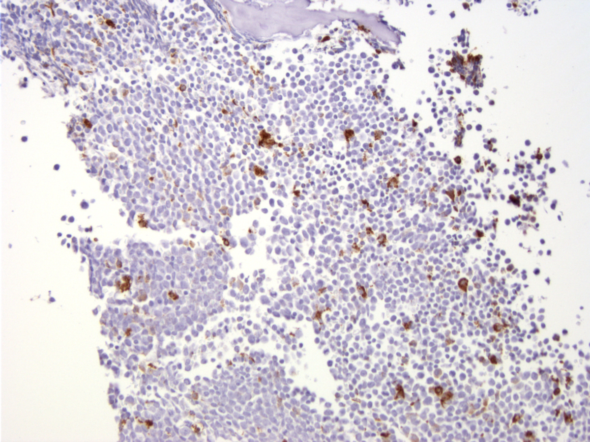 Bone marrow core biopsy section (BM-1), CD68 immunoperoxidase stain, x200